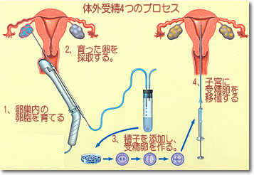 体外受精４つのプロセス